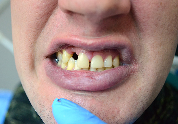 Voici à quoi ressemblaient les dents du patient avant d'utiliser une prothèse papillon ...