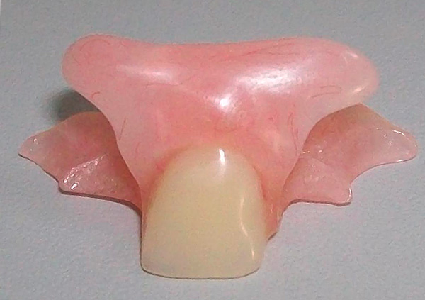 Prothèse papillon pour prothèses de la dent avant (incisive)
