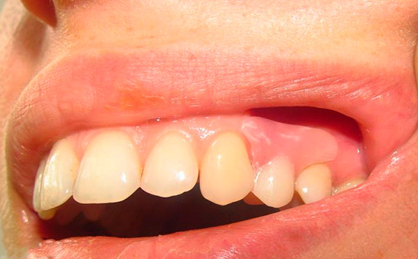 La dent restaurée par la prothèse est pratiquement impossible à distinguer des dents natives du patient.