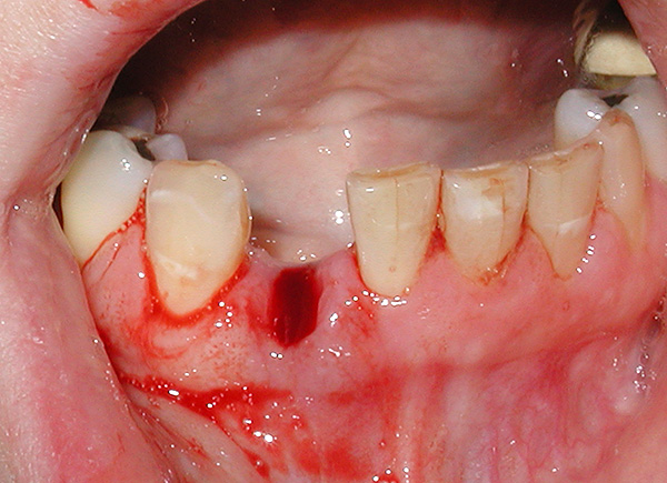 Lors de l'utilisation de la prothèse implantaire, il n'est pas nécessaire de marcher pendant plusieurs semaines avec un trou dans la dentition.
