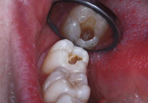 Parfois, il semble aux patients que le médecin perce trop diligemment une dent, comme s'il recevait du plaisir de ce processus ...