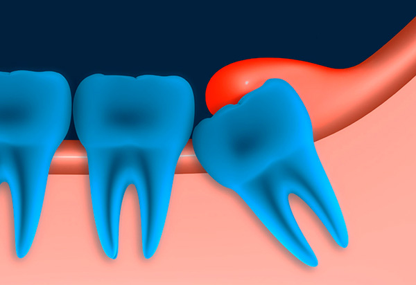 Souvent, un capuchon gingival se forme sur une dent de sagesse partiellement éclatée - son inflammation peut créer les conditions préalables à la suppression du chiffre huit.