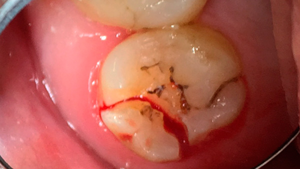 Si la dent (n'importe laquelle) tombe en panne de sorte que la fissure pénètre profondément sous la gencive, alors, en règle générale, les possibilités de prothèses sont considérablement limitées.