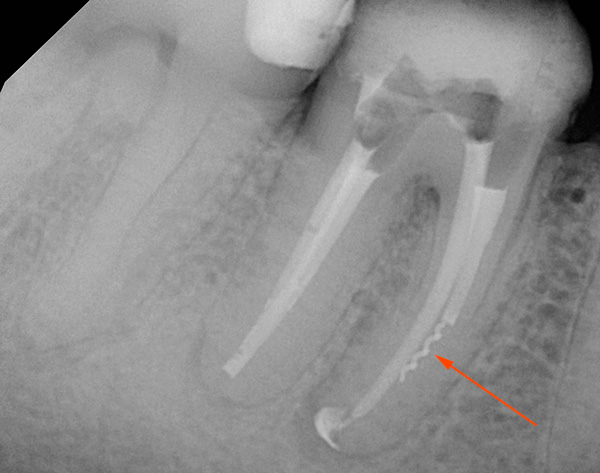 Le fragment de l'instrument dentaire qui reste dans le canal est clairement visible sur l'image - s'il n'est pas retiré, il peut à l'avenir provoquer une inflammation au sommet de la racine de la dent.