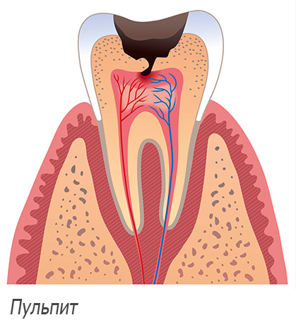 La pulpite de la dent est schématisée sur l'image.