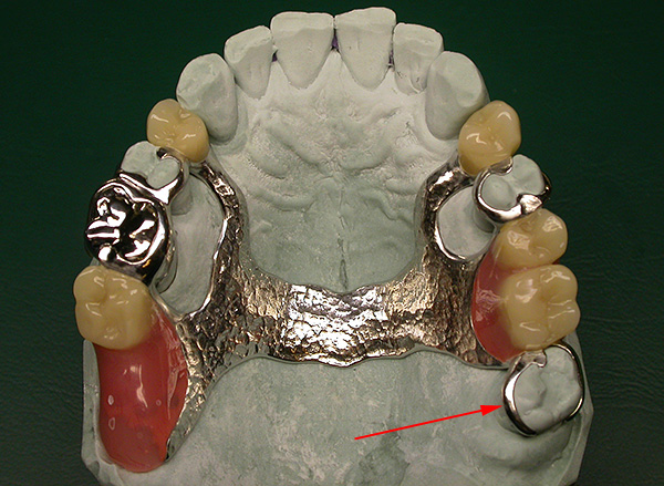 Les dents de sagesse peuvent être utilisées comme support pour les prothèses dentaires.