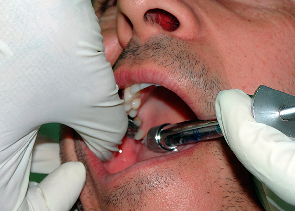 L'utilisation efficace d'un anesthésique permet de traiter les dents de sagesse de manière absolument indolore (dans la plupart des cas).