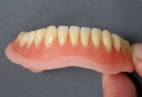 Même une prothèse très sombre peut être pratiquement restaurée dans son état d'origine en laboratoire dentaire.