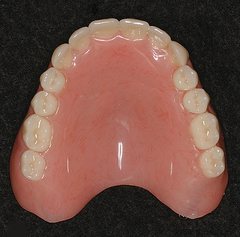 Les prothèses en plastique acrylique rigide restent aujourd'hui l'option la moins chère pour les prothèses avec une absence totale de dents dans la bouche.