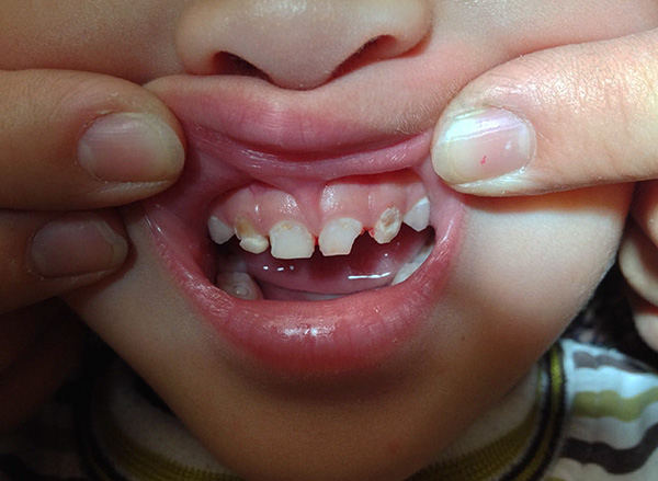 À propos des moyens de soulager les maux de dents chez les enfants ...