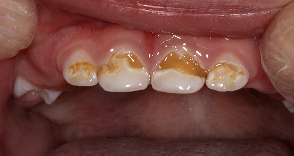 En cas de dommages profonds à l'émail, une variété d'irritants peut provoquer de graves maux de dents: chimiques, thermiques et mécaniques.