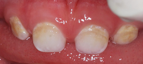 Carie des dents caduques au stade d'une tache blanche (craie).