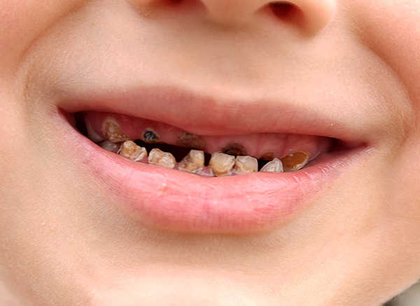 Si vous ne surveillez pas l'état des dents du bébé, cela peut former des complexes psychologiques, qui persistent parfois pendant de nombreuses années.