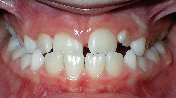 La malocclusion peut se produire, entre autres, en raison de la perte prématurée de dents à feuilles caduques détruites par des caries.